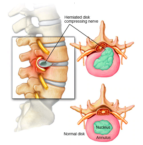 Image of herniated disk.